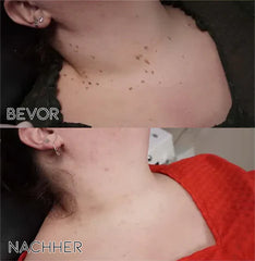 GlowQuell — Clear Spots Instantly Without Pain or Irritation